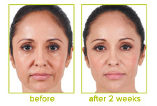 Juvederm XC Before and After Photos