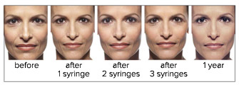 Juvederm XC Progressive Photos