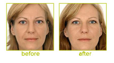 Restylane Before and After Photos