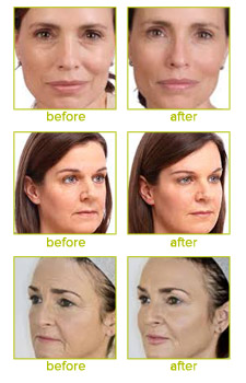 Voluma Before and After Photos