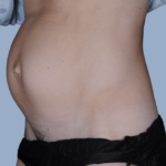 patient1-before-quart