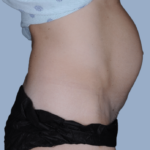 patient1-before-side1