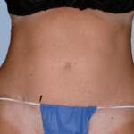 patient2-after-front