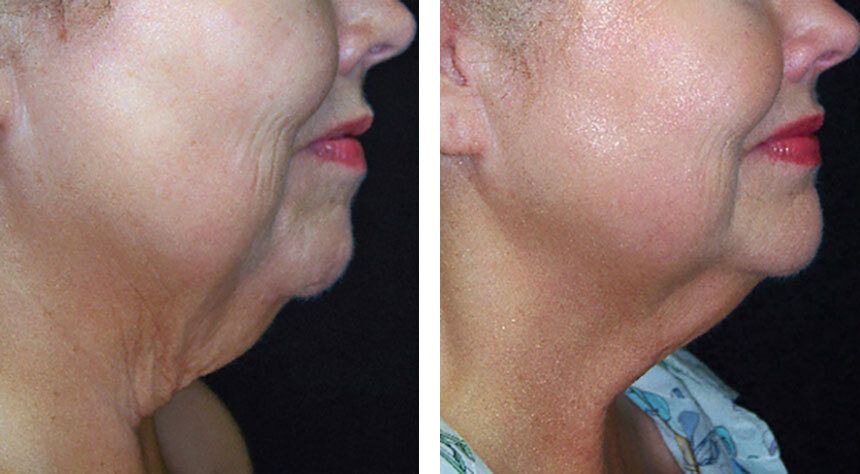 skintyte skin tightening before and after
