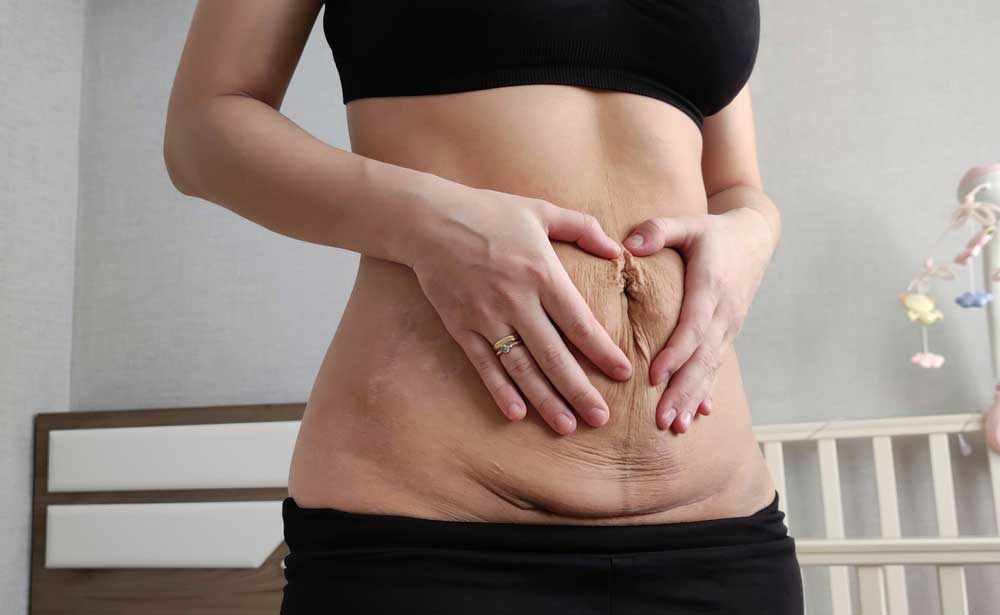 patient planning mommy makeover
